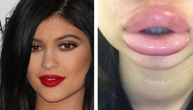 Kylie Jenner Lip Challenge